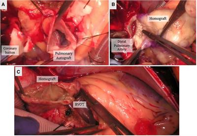 Treatment options for isolated aortic valve insufficiency: a review